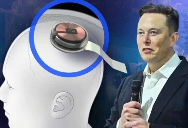 Musk's company Neuralink implants neurochip into human brain for first time